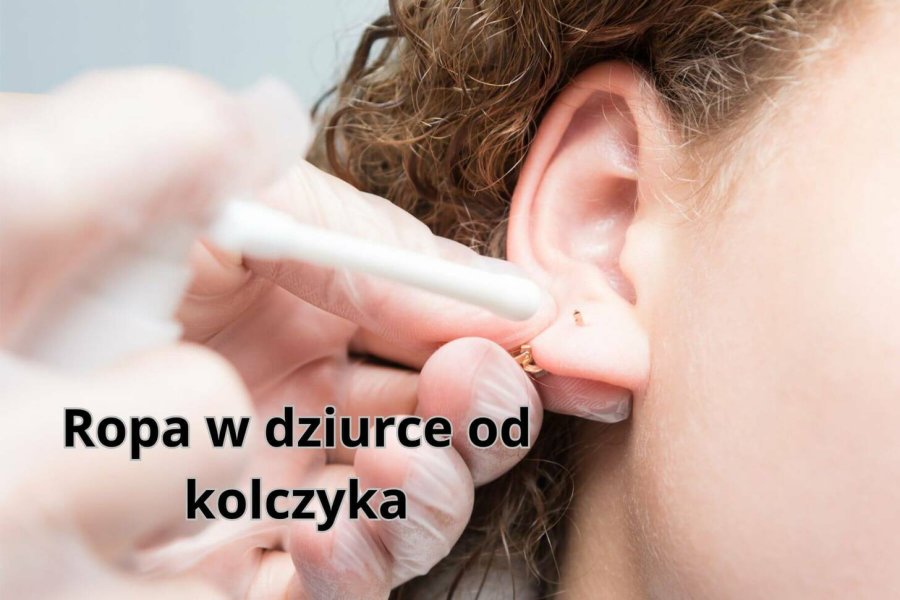 Ropa w dziurce od kolczyka: jakie są jej przyczyny?